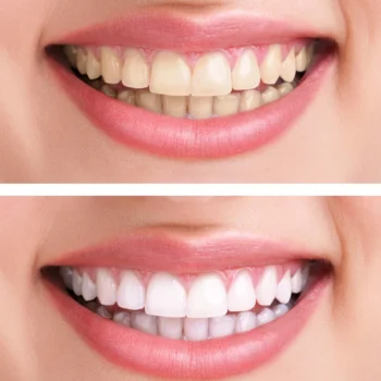 Before and after smile showing results of teeth cleaning in Antioch