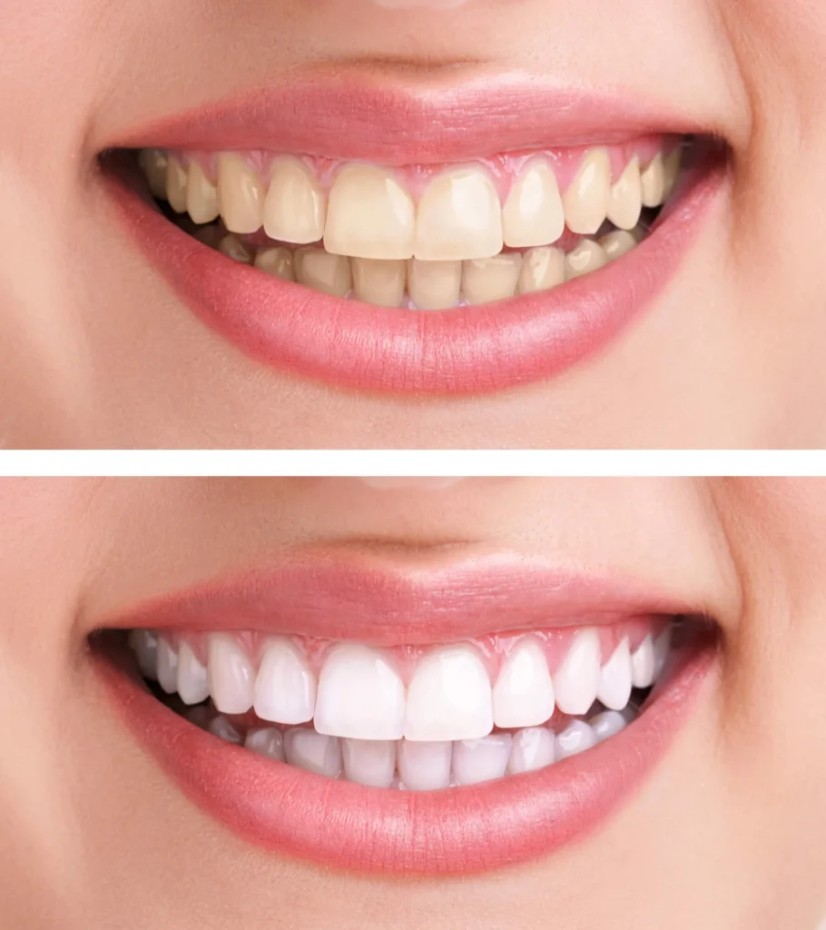 Before and after smile showing results of teeth cleaning in Antioch