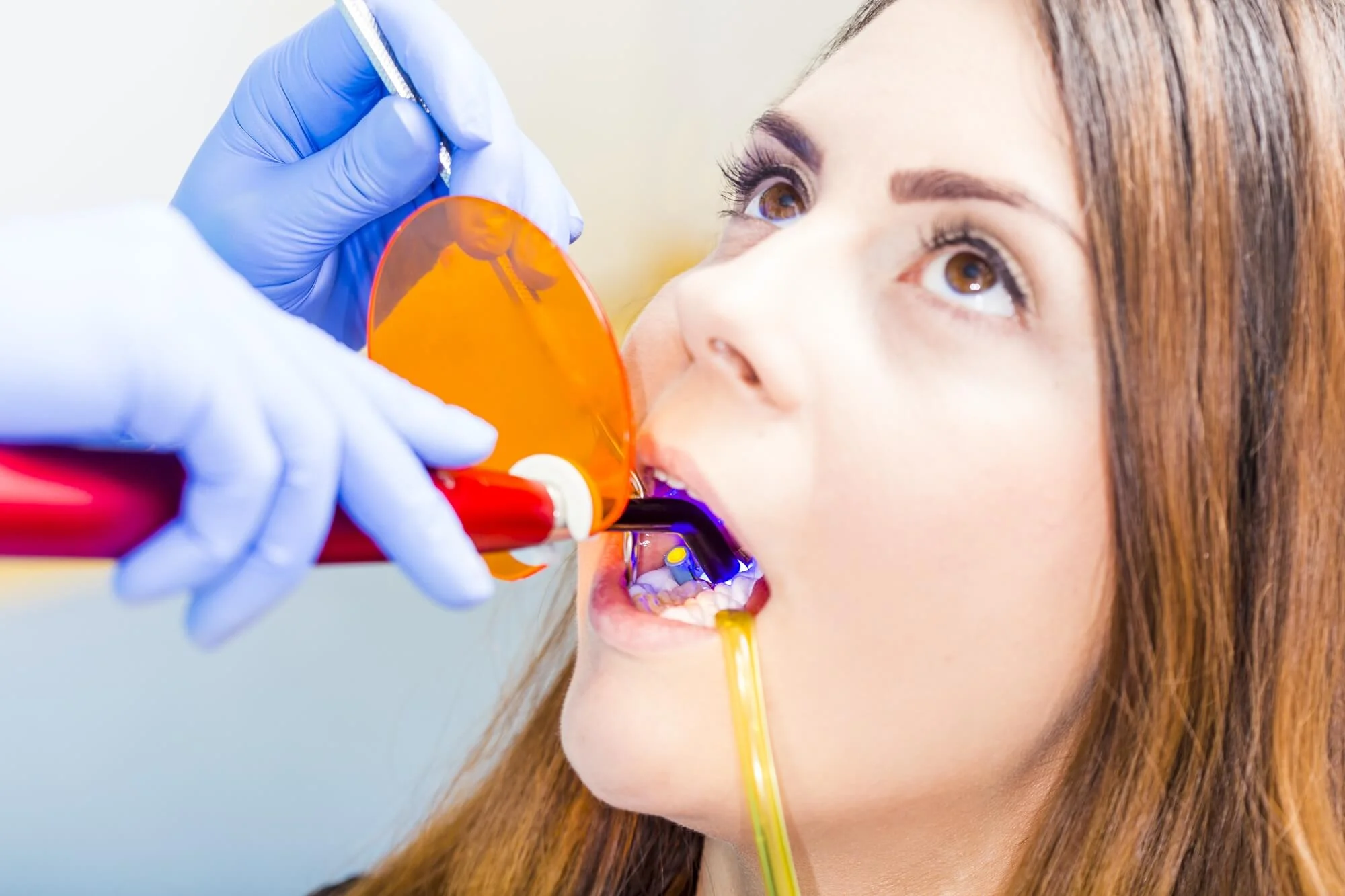Patient-getting-bonding-at-affordable-dentist-in-Antioch-TN
